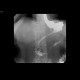 Duodenal stent, migration of stent: RF - Fluoroscopy